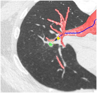 Use of the Archimedes navigation system to diagnose peripheral pulmonary lesions: preliminary Italian results
